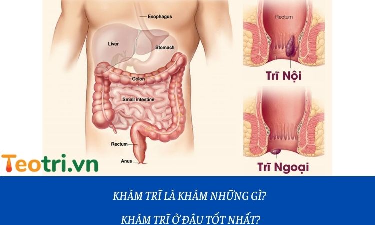 Khám trĩ là khám những gì? Khám trĩ ở đâu tốt nhất?