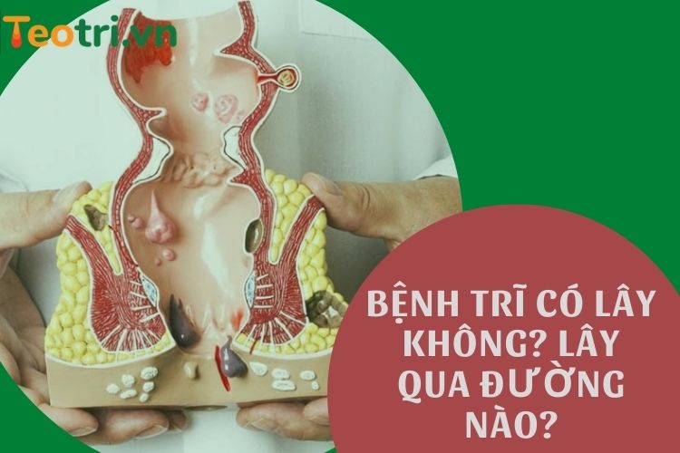 Bệnh trĩ có lây không? Bệnh lây qua đường nào?