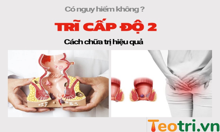 Bệnh trĩ độ 2 có nguy hiểm không? Tổng hợp cách chữa hiệu quả nhất