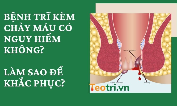 Bệnh trĩ kèm chảy máu có nguy hiểm không? Làm sao để khắc phục