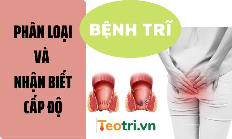 Phân loại và nhận biết các cấp độ của bệnh trĩ cụ thể