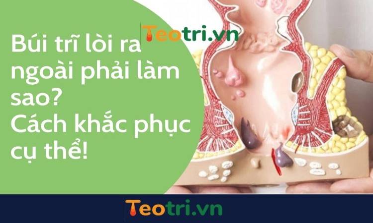 Búi trĩ lòi ra ngoài phải làm sao? Cách khắc phục cụ thể