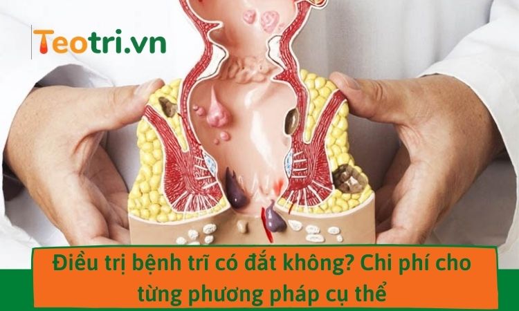 Điều trị bệnh trĩ có đắt không? Chi phí cho từng phương pháp cụ thể