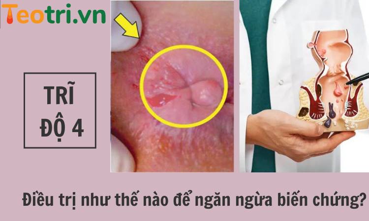 Trĩ độ 4: Điều trị như thế nào để ngăn ngừa biến chứng?