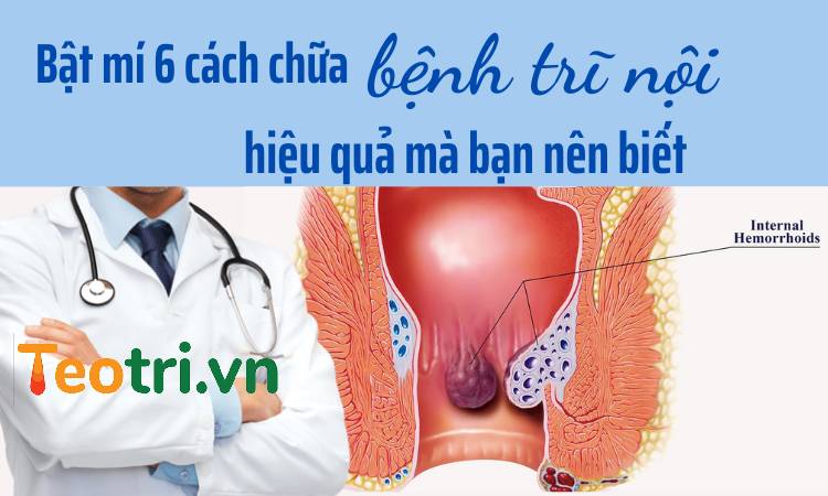 Bật mí 6 cách chữa bệnh trĩ nội hiệu quả mà bạn nên biết