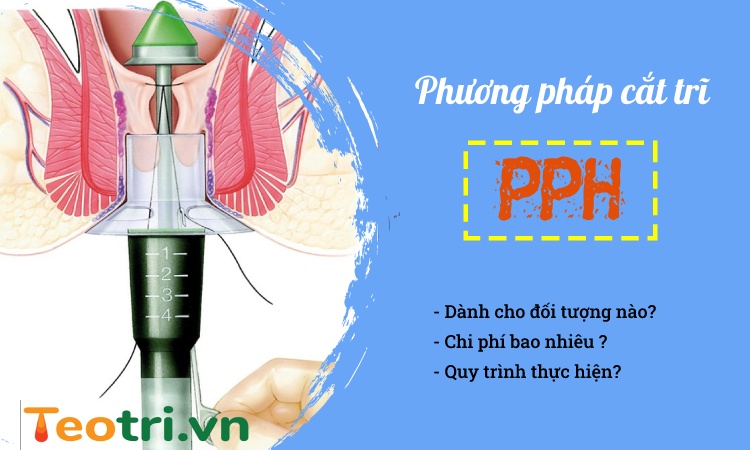 Cắt trĩ bằng phương pháp PPH có an toàn và hiệu quả không? Chi phí hết bao nhiêu?