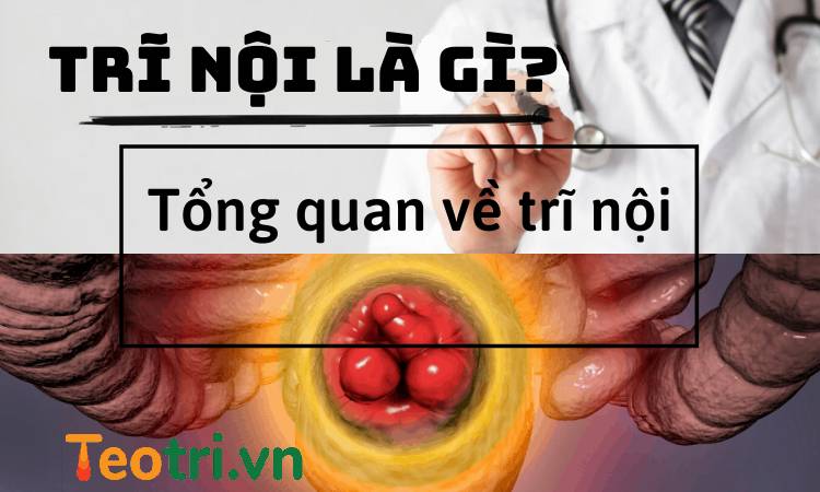 Bệnh trĩ nội là gì? Mọi điều cần biết khi bị trĩ nội