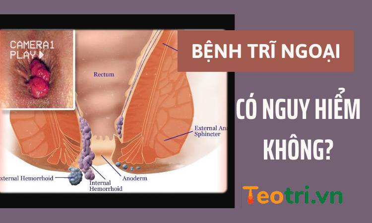 Bệnh trĩ ngoại có nguy hiểm không?