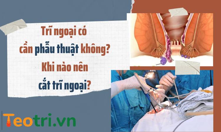 Trĩ ngoại có cần phẫu thuật không? Khi nào nên cắt trĩ ngoại?