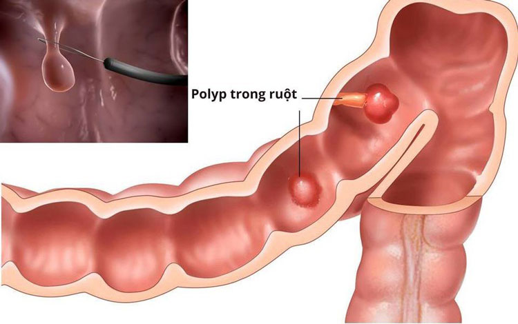Polyp đại tràng – dạ dày 1