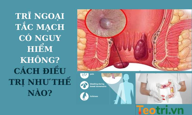 Trĩ ngoại tắc mạch có nguy hiểm không? Cách điều trị như thế nào?