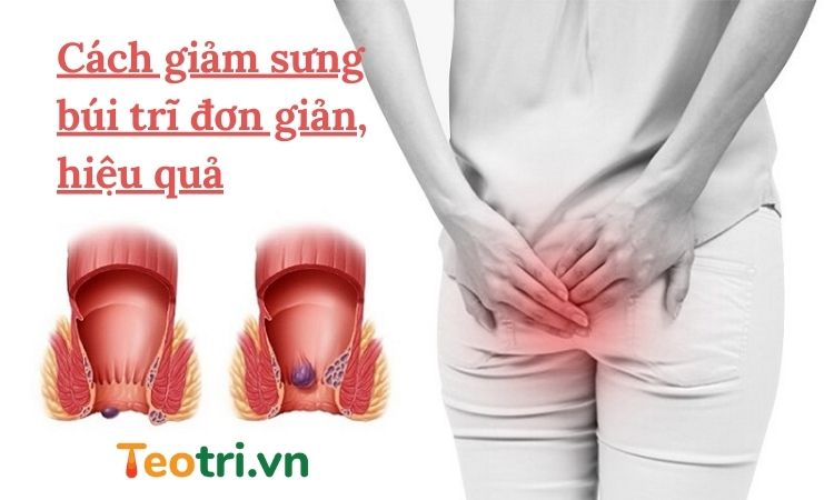 Cách giảm sưng búi trĩ đơn giản, hiệu quả cao - Bạn đã biết chưa?