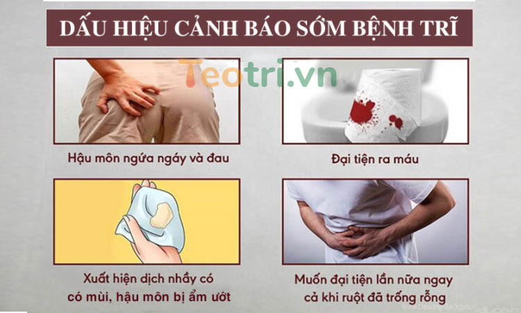 4 dấu hiệu cảnh báo mắc trĩ 2