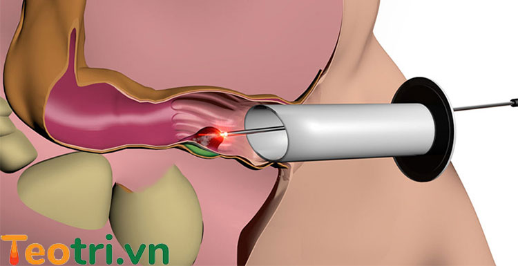 Phẫu thuật cắt trĩ vòng PPH 1