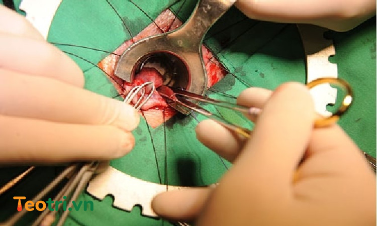 Phẫu thuật cắt trĩ 1